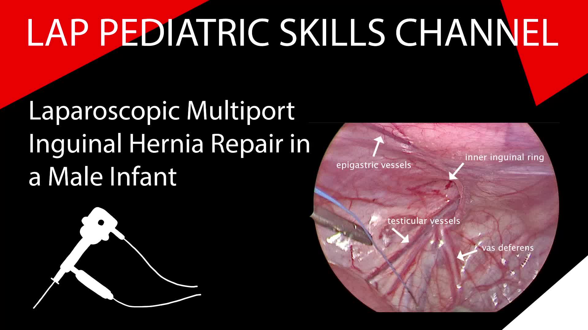 Laparoscopic Multiport Inguinal Hernia Repair ina Male Infant