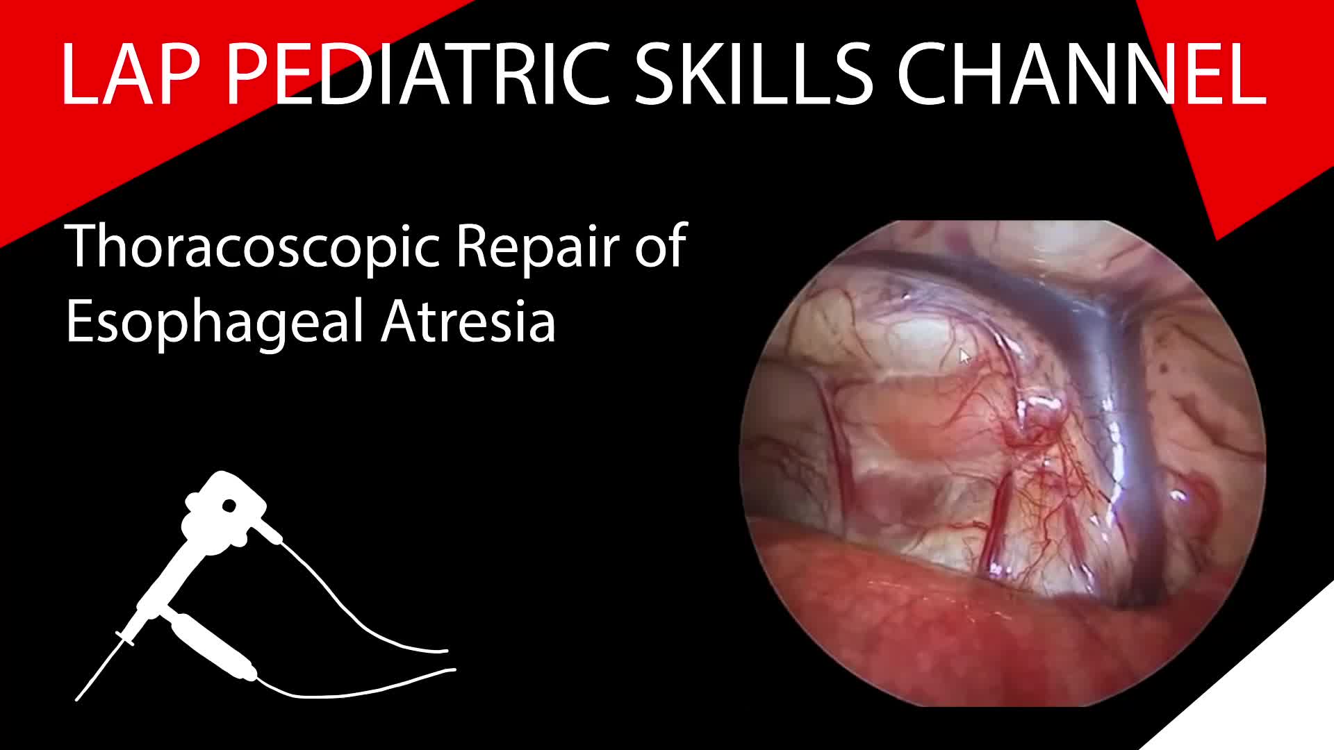 Thoracoscopic Repair of Esophageal Atresia