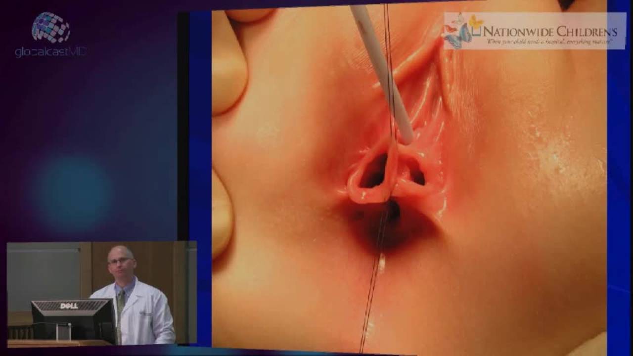 Surgical Management Of Female Anorectal Malformation Patients Including...