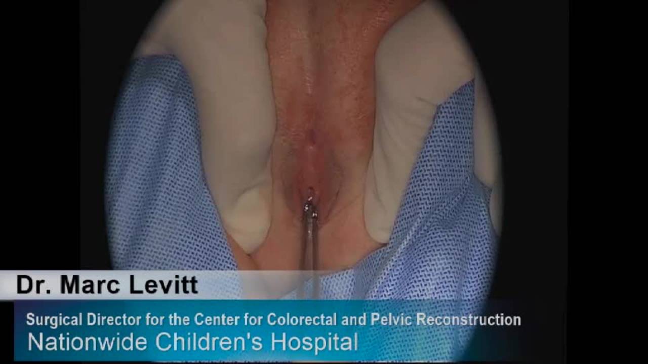 Technique: Female PSARP