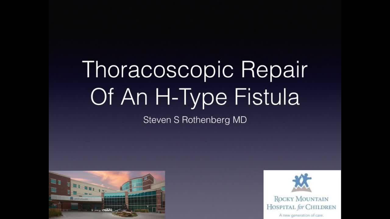 VATS H-Type Fistula Repair - Technique