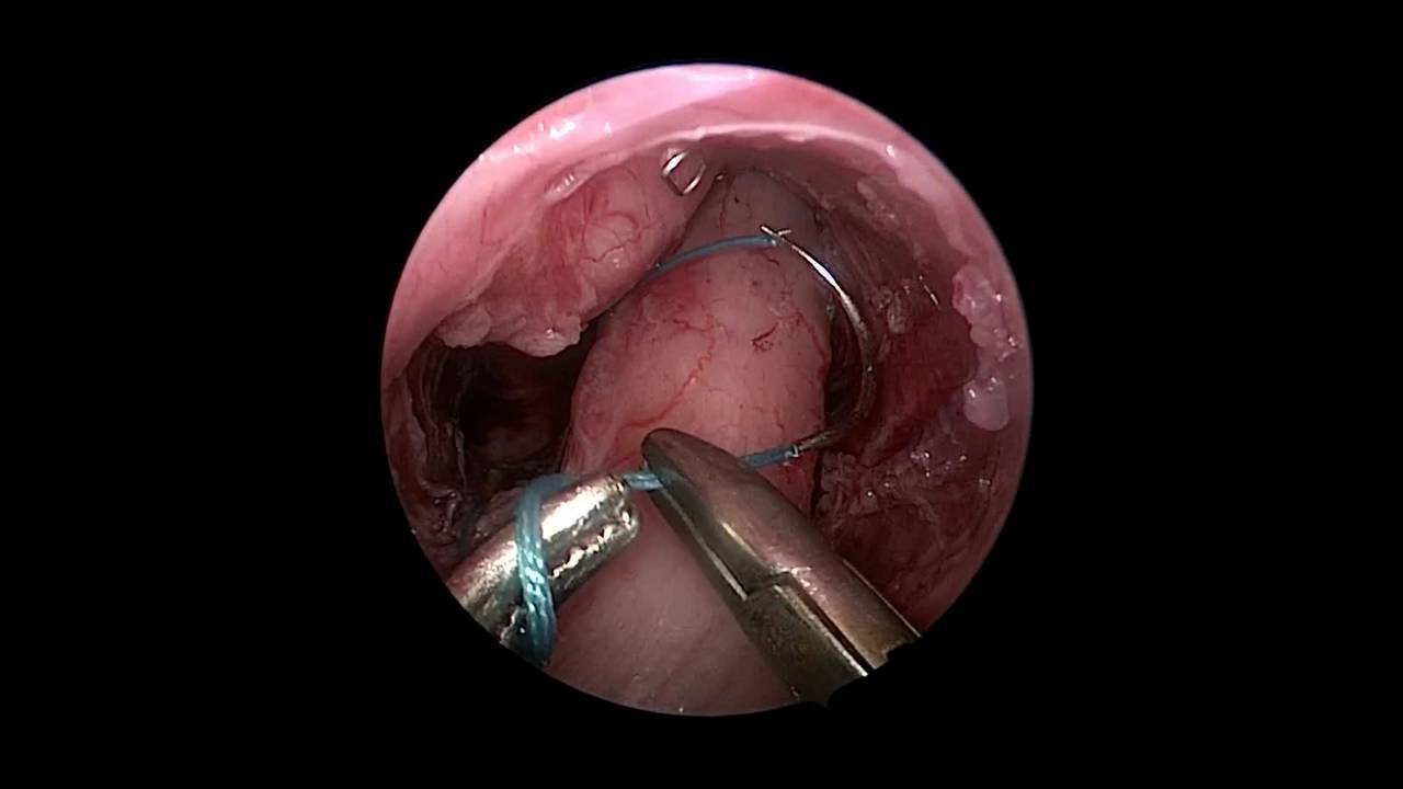 Technique: Laparoscopic-Assisted Pull-through for Imperforate Anus
