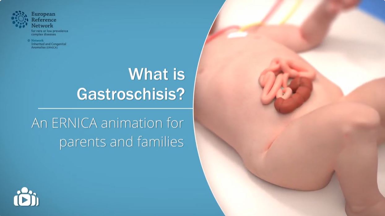 What is Gastroschisis? An ERNICA animation for parents and families