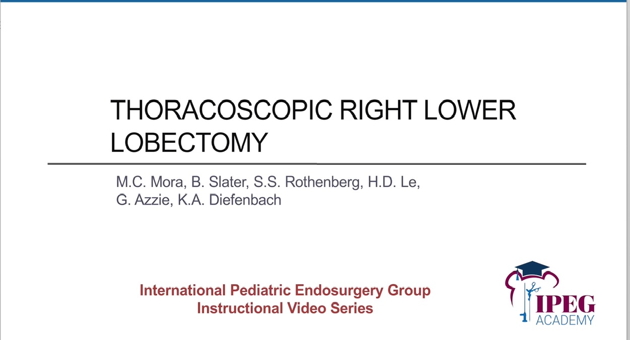 IPEG Academy: Thoracoscopic Right Lower Lobectomy
