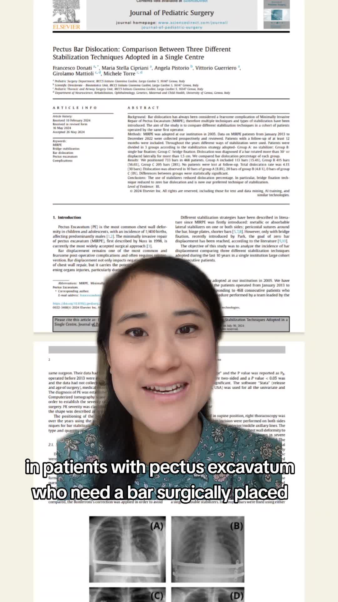 Pectus Bar Dislocation: Comparison Between Three Different Stabilization Techniques Adopted in a Single Centre