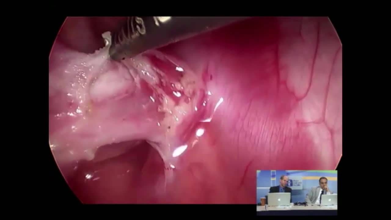 Left Lower Lobectomy for Sequestration: Pediatric Thoracic Surgery Part...