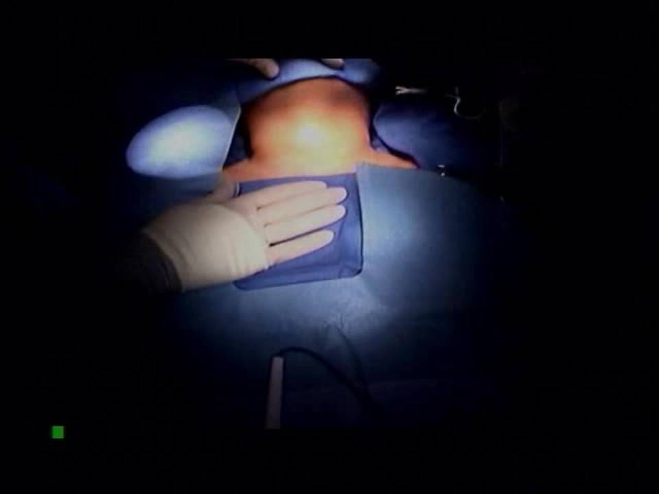 Thyroidectomy: Technique