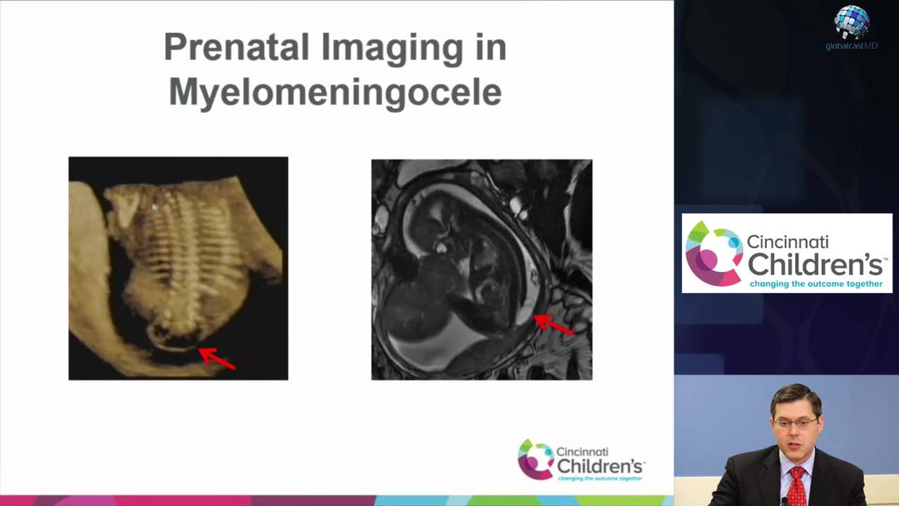 Spina Bifida: Prenatal Imaging Modalities