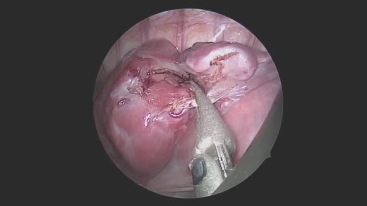 Technique: Right Upper Lobectomy