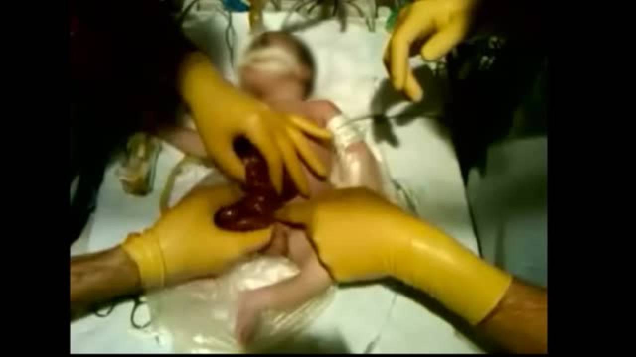 Sutureless Gastroschisis Repair: Technique