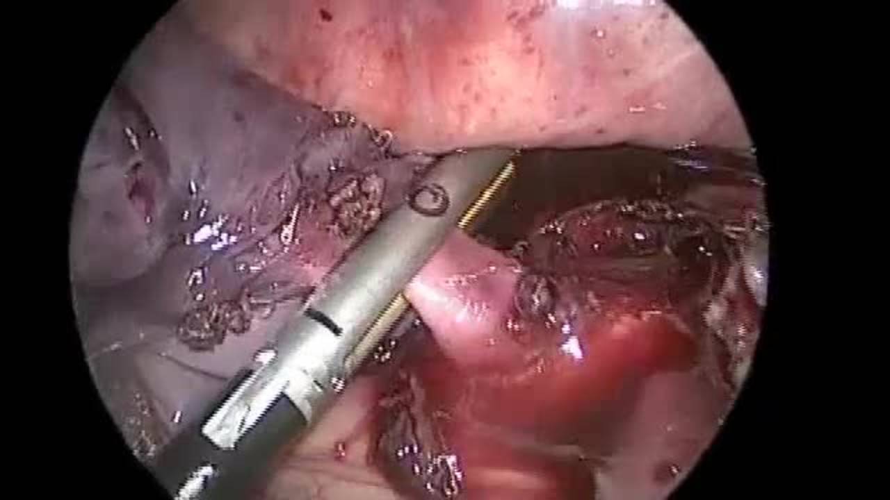 Technique: Intralobar Right Lower Lobectomy