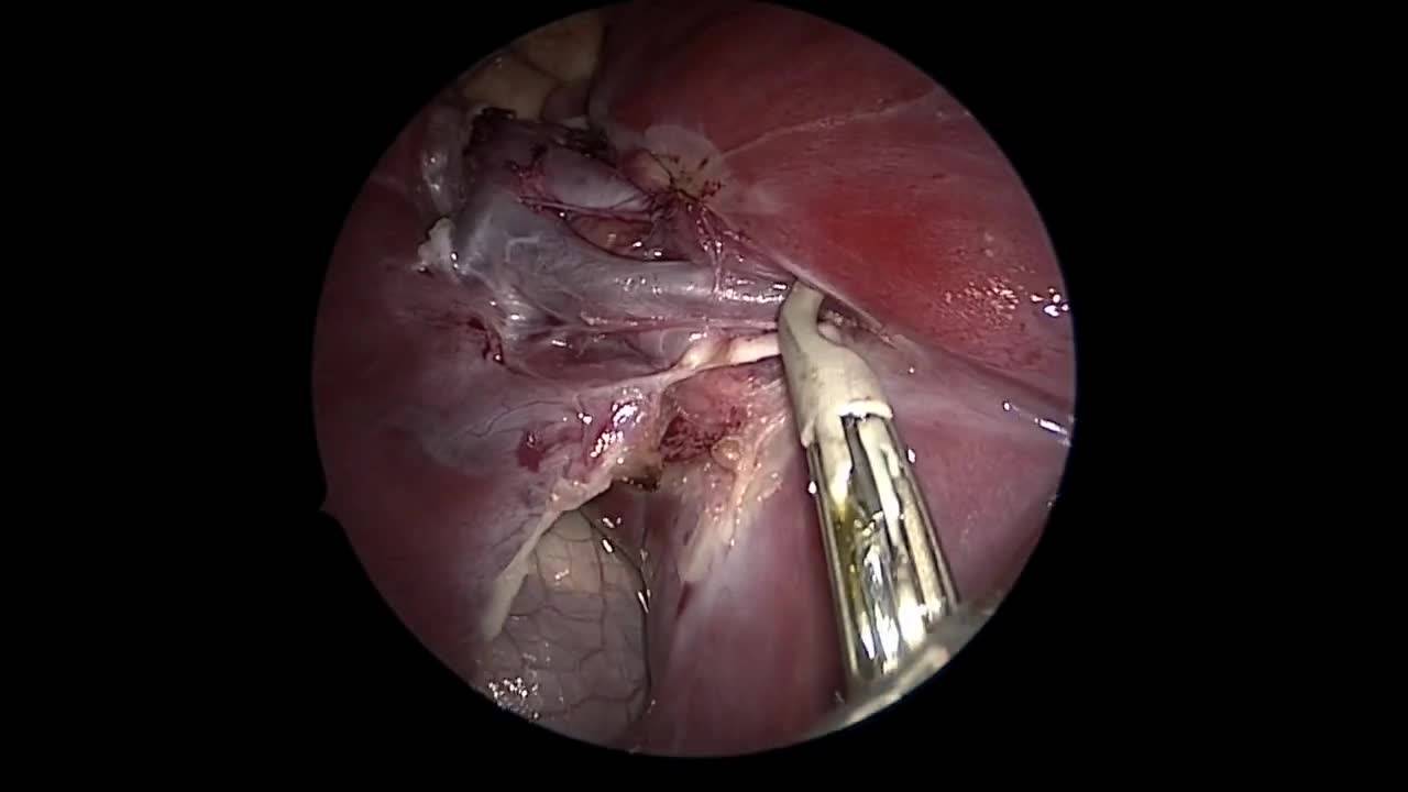 Thoracoscopic Left Lower Lobectomy Technique by Dr. Steven Rothenberg: How I...